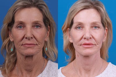 Facelift Before & After Gallery - Patient 122406187 - Image 1