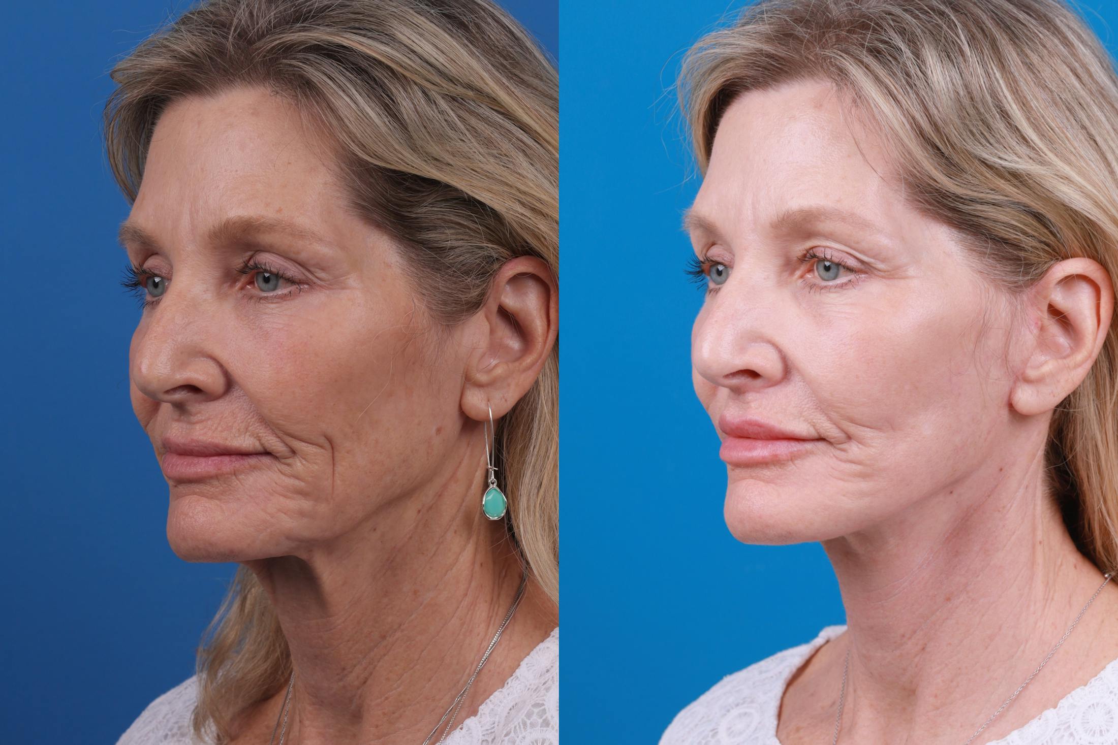 Facelift Before & After Gallery - Patient 122406187 - Image 2