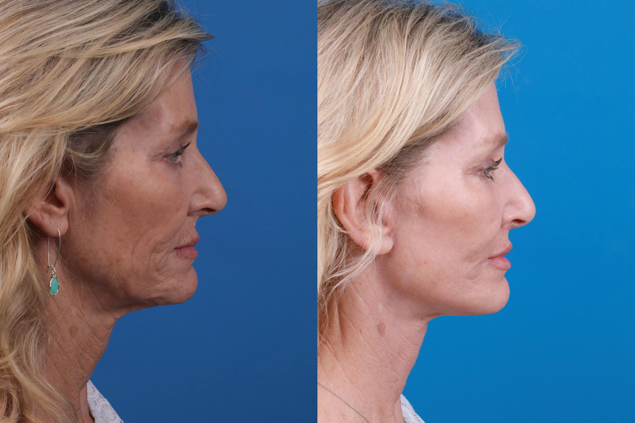 Facelift Before & After Gallery - Patient 122406187 - Image 3