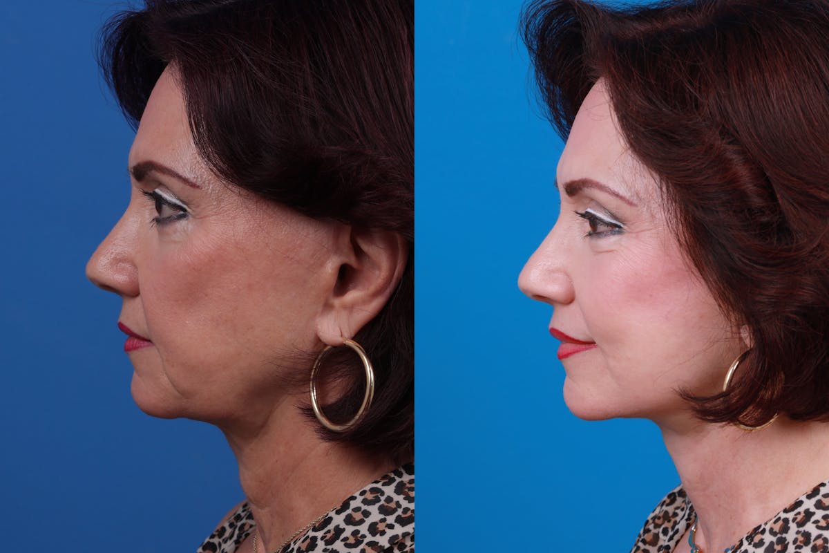 Facelift Before & After Gallery - Patient 122406192 - Image 1