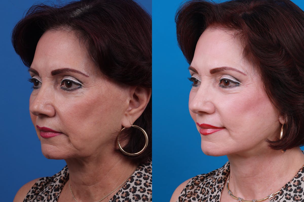 Facelift Before & After Gallery - Patient 122406192 - Image 2