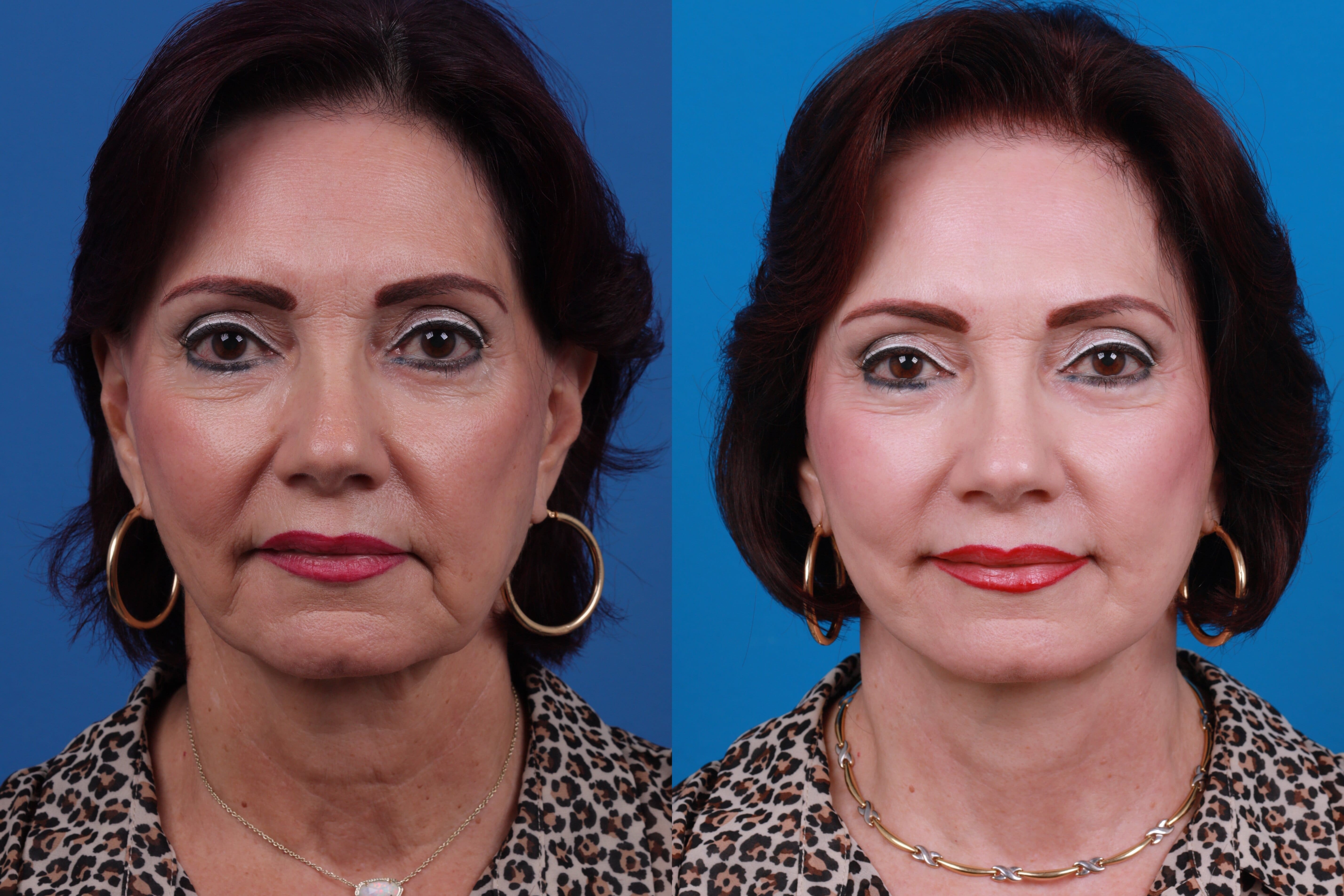 Facelift Before & After Gallery - Patient 122406192 - Image 3