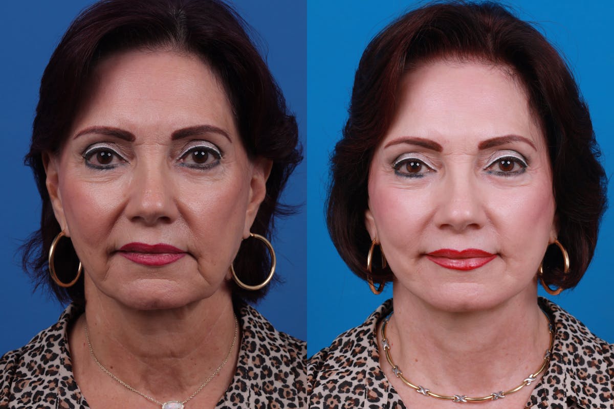 Facelift Before & After Gallery - Patient 122406192 - Image 3