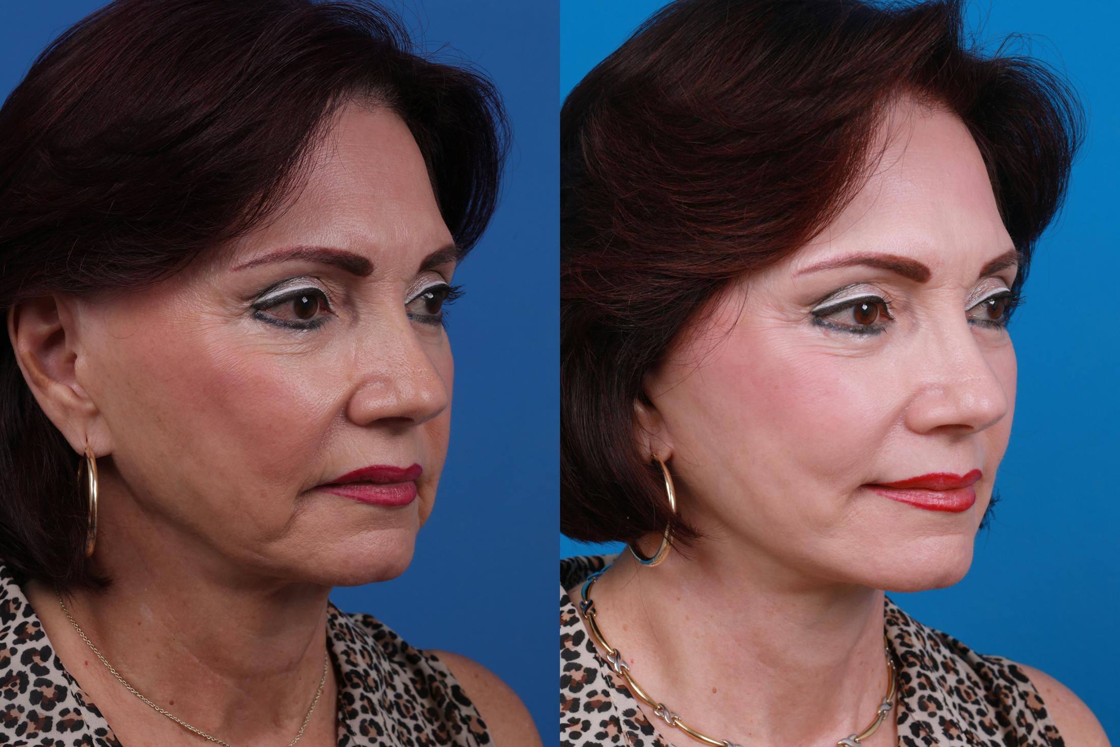 Facelift Before & After Gallery - Patient 122406192 - Image 4