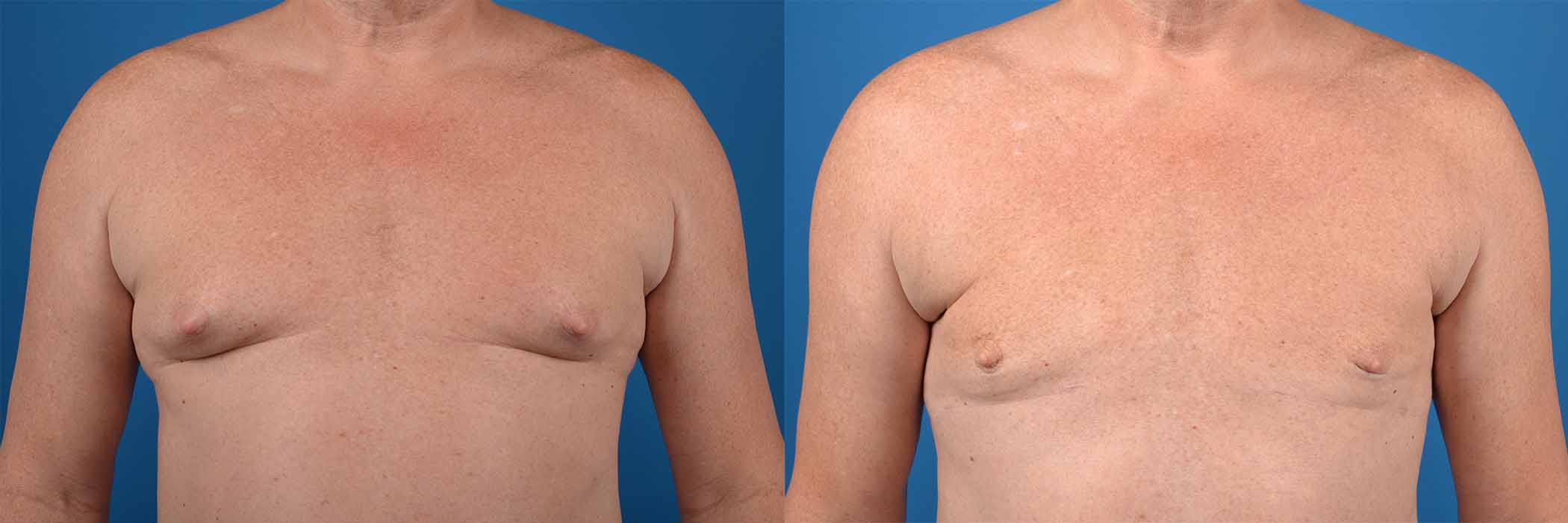 HIdden Male Breast Reduction (Gynecomastia) Before & After Gallery - Patient 166252 - Image 1