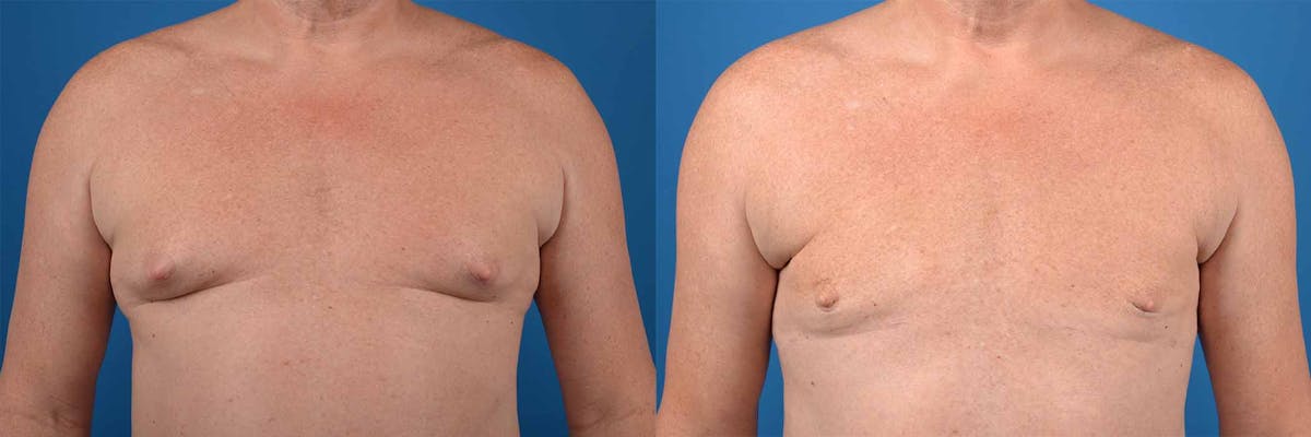 Male Breast Reduction (Gynecomastia) Before & After Gallery - Patient 940682 - Image 1
