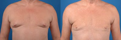 Male Breast Reduction (Gynecomastia) Before & After Gallery - Patient 122406196 - Image 1
