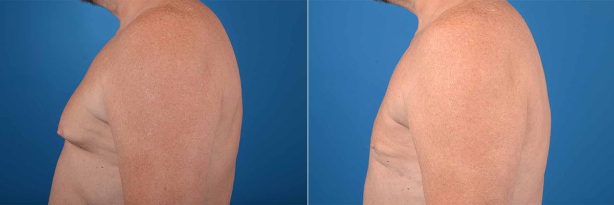 Male Breast Reduction (Gynecomastia) Before & After Gallery - Patient 940682 - Image 2