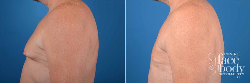 HIdden Male Breast Reduction (Gynecomastia) Before & After Gallery - Patient 166252 - Image 2