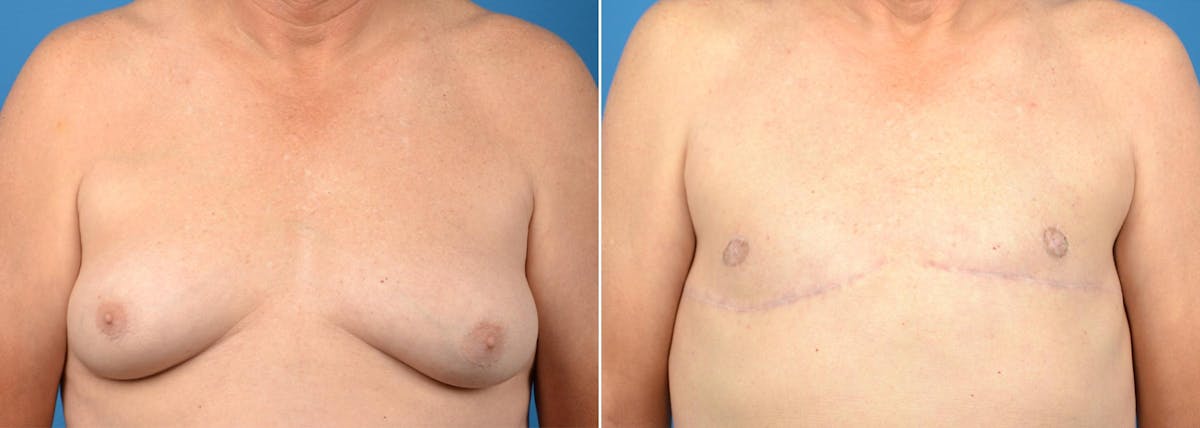 Male Breast Reduction (Gynecomastia) Before & After Gallery - Patient 168830 - Image 1