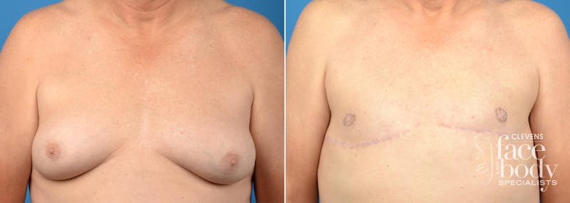 HIdden Male Breast Reduction (Gynecomastia) Before & After Gallery - Patient 204203 - Image 1
