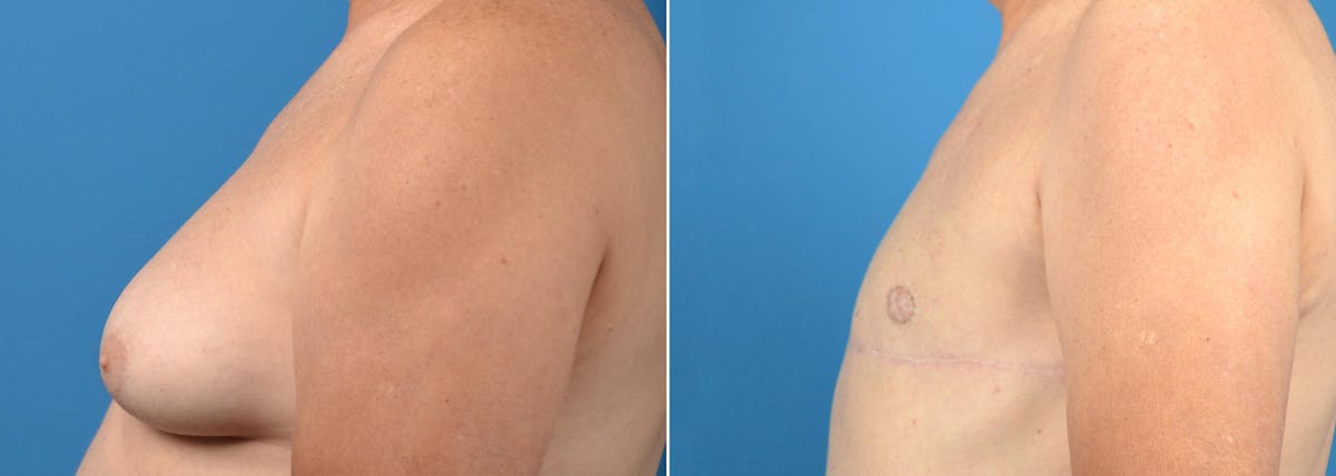 Male Breast Reduction (Gynecomastia) Before & After Gallery - Patient 168830 - Image 2