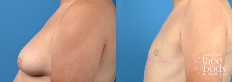 HIdden Male Breast Reduction (Gynecomastia) Before & After Gallery - Patient 204203 - Image 2