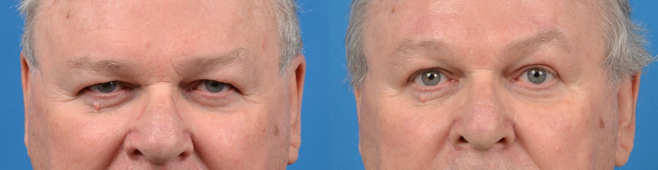Male Brow Lift Before & After Gallery - Patient 122406201 - Image 1