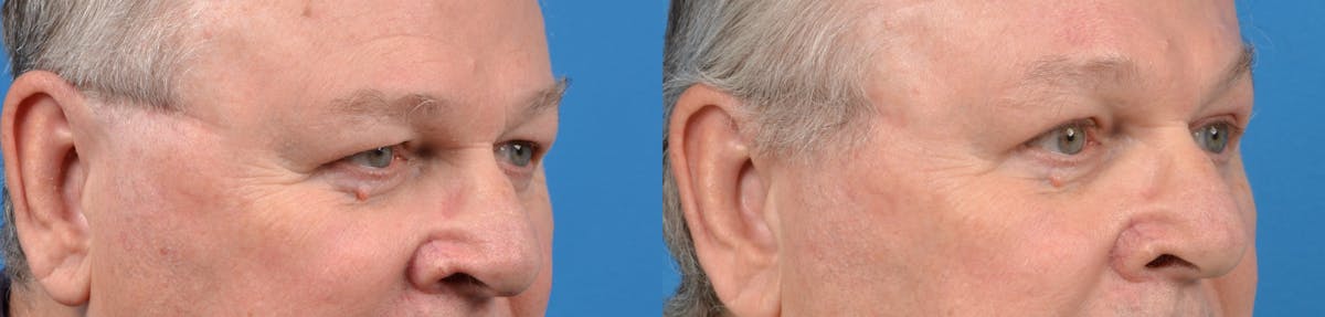 Male Brow Lift Before & After Gallery - Patient 122406201 - Image 2