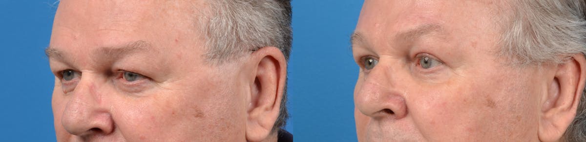 Male Brow Lift Before & After Gallery - Patient 122406201 - Image 3