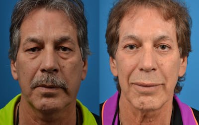 Male Brow Lift Before & After Gallery - Patient 122406204 - Image 1