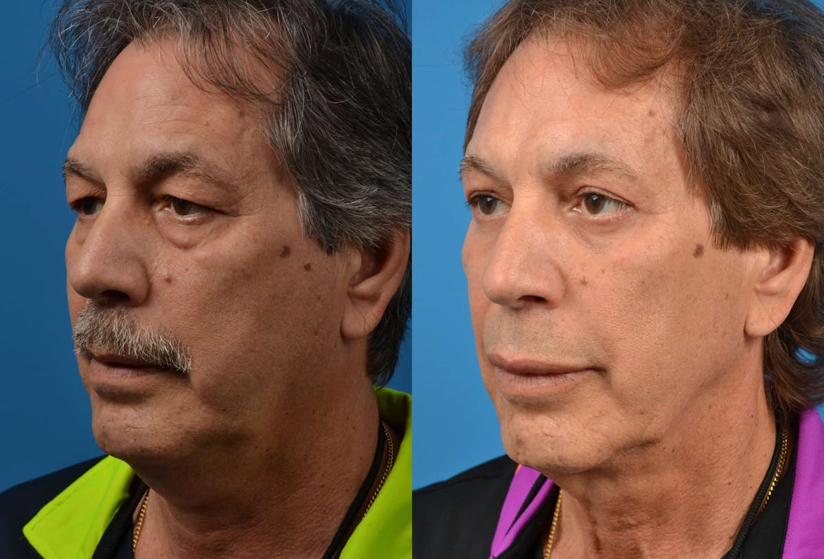 Male Brow Lift Before & After Gallery - Patient 122406204 - Image 2