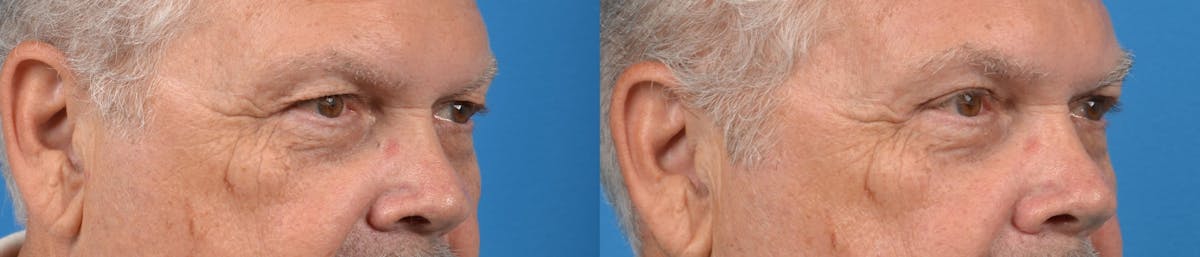 Male Brow Lift Before & After Gallery - Patient 122406207 - Image 2