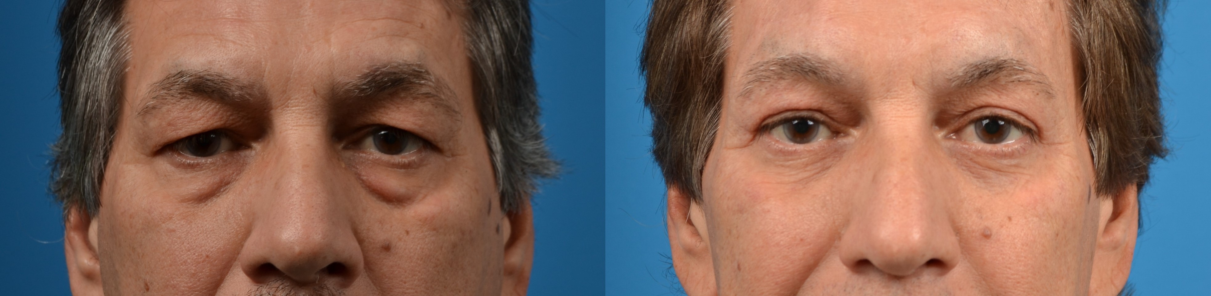 Male Eyelid Surgery Before & After Gallery - Patient 122406208 - Image 1