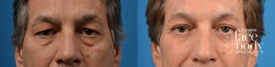 Eyelid Surgery Before & After Gallery - Patient 101814 - Image 1