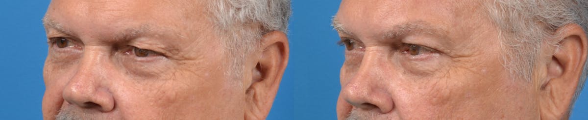 Male Brow Lift Before & After Gallery - Patient 122406207 - Image 3