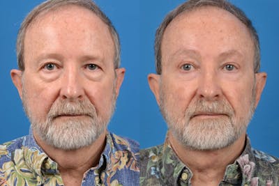 Male Brow Lift Before & After Gallery - Patient 122406210 - Image 1