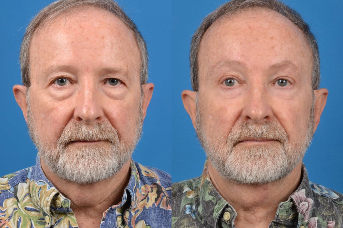 Male Brow Lift Before & After Gallery - Patient 122406210 - Image 1