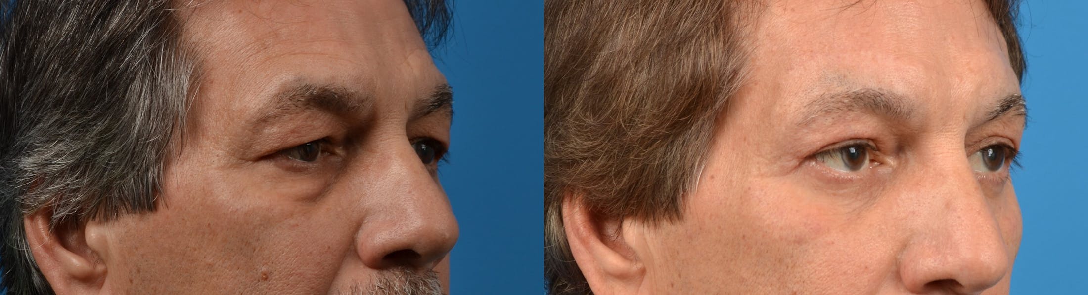 Male Eyelid Surgery Before & After Gallery - Patient 122406208 - Image 3