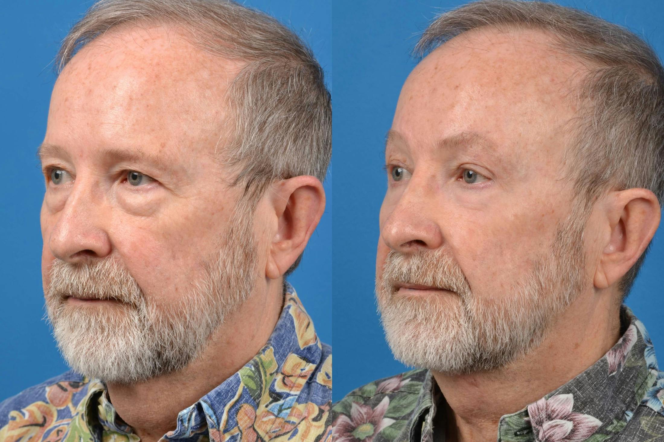Male Brow Lift Before & After Gallery - Patient 122406210 - Image 2