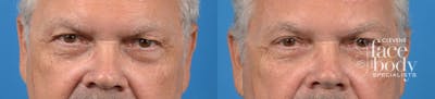 Eyelid Surgery Before & After Gallery - Patient 107488 - Image 1