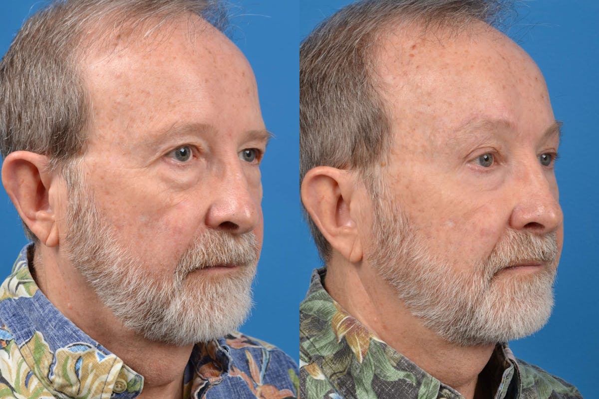 Male Brow Lift Before & After Gallery - Patient 122406210 - Image 3