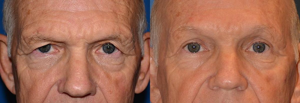 Male Brow Lift Before & After Gallery - Patient 122406212 - Image 1