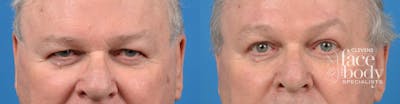 Eyelid Surgery Before & After Gallery - Patient 117148 - Image 1