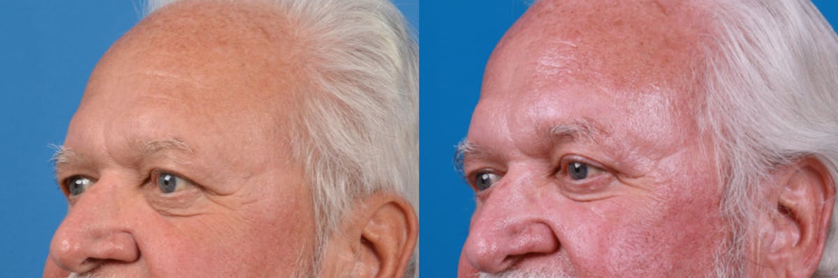 Male Brow Lift Before & After Gallery - Patient 122406215 - Image 1