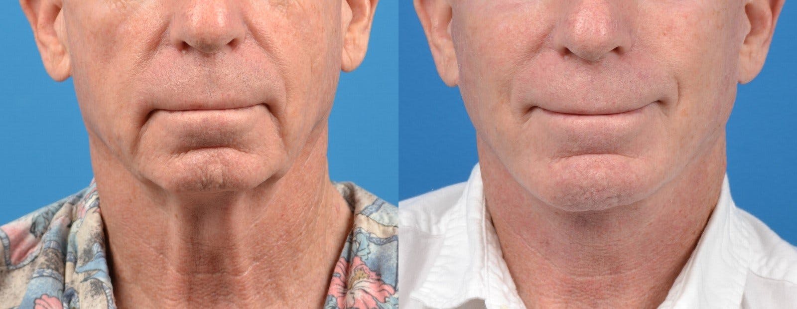 Male Facelift Before & After Gallery - Patient 122406217 - Image 1