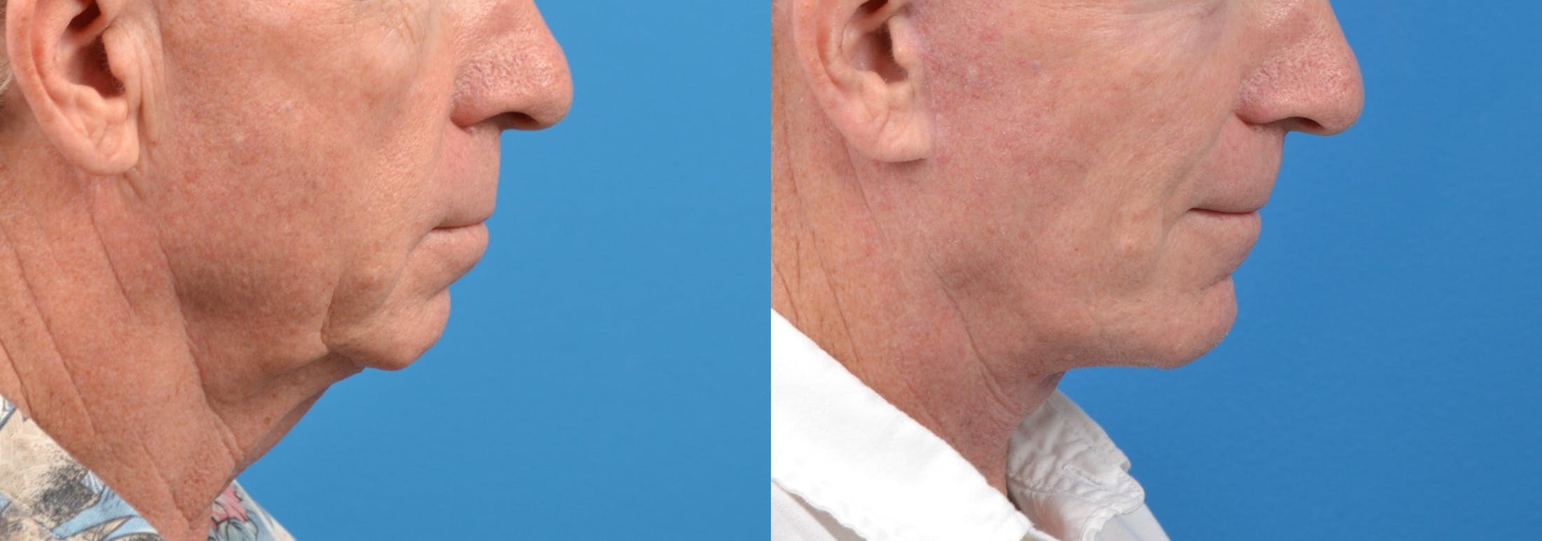 Male Facelift Before & After Gallery - Patient 122406217 - Image 2