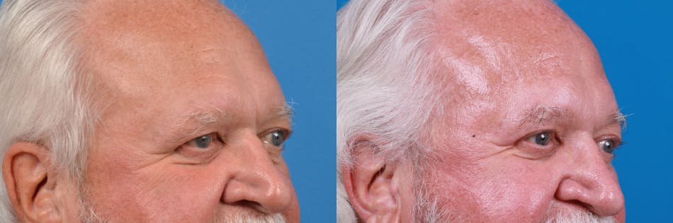 Male Brow Lift Before & After Gallery - Patient 122406215 - Image 3