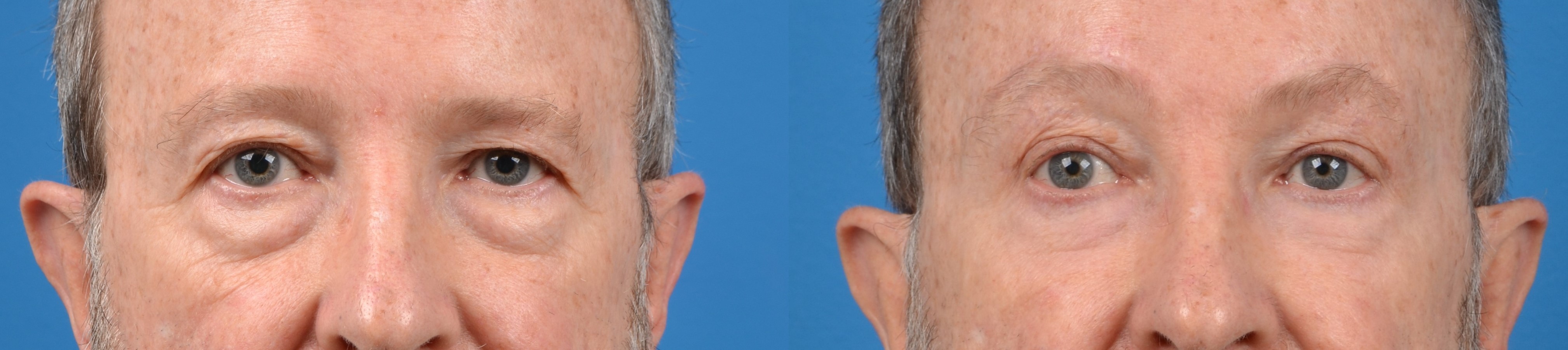 Male Eyelid Surgery Before & After Gallery - Patient 122406219 - Image 1