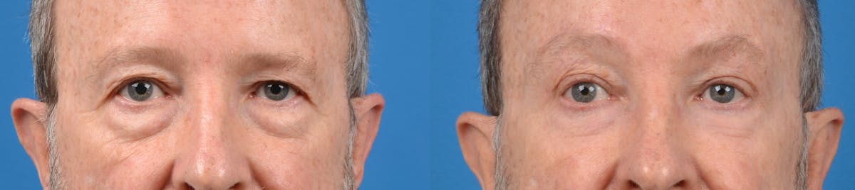 Male Eyelid Surgery Before & After Gallery - Patient 122406219 - Image 1