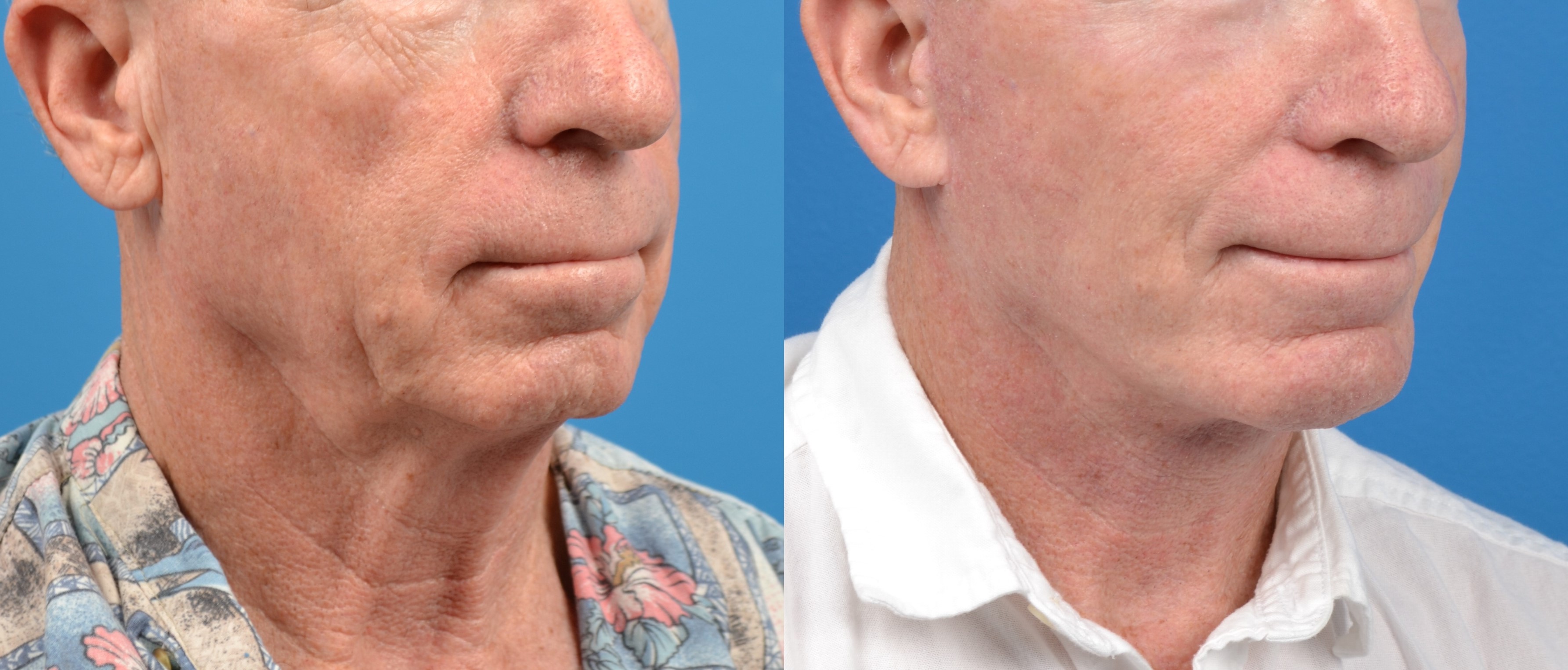 Male Facelift Before & After Gallery - Patient 122406217 - Image 3