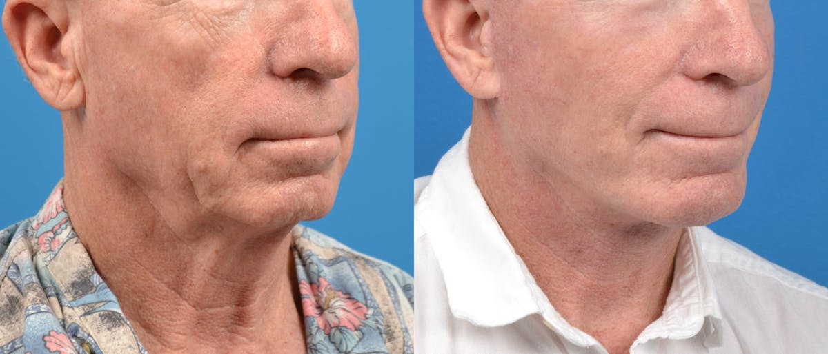 Male Facelift Before & After Gallery - Patient 122406217 - Image 3