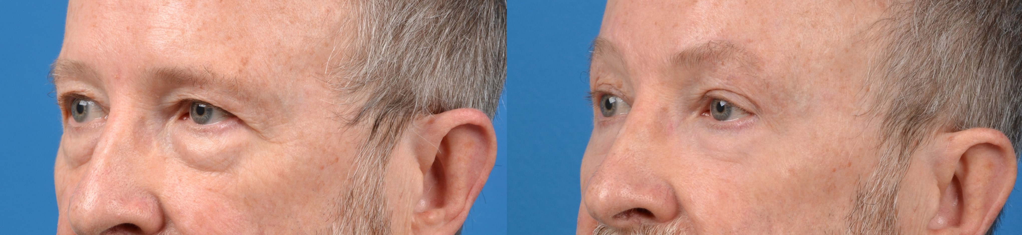 Eyelid Surgery Before & After Gallery - Patient 202740 - Image 2