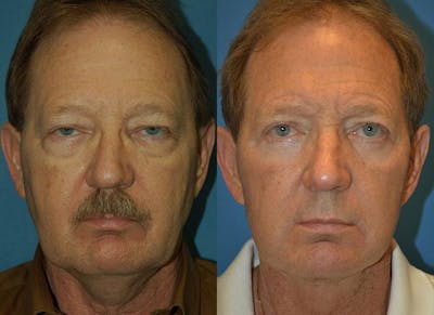 Male Facelift Before & After Gallery - Patient 122406220 - Image 1