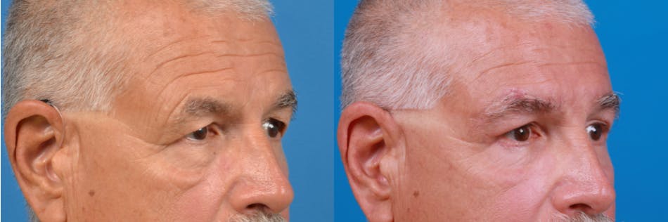 Male Brow Lift Before & After Gallery - Patient 122406218 - Image 3