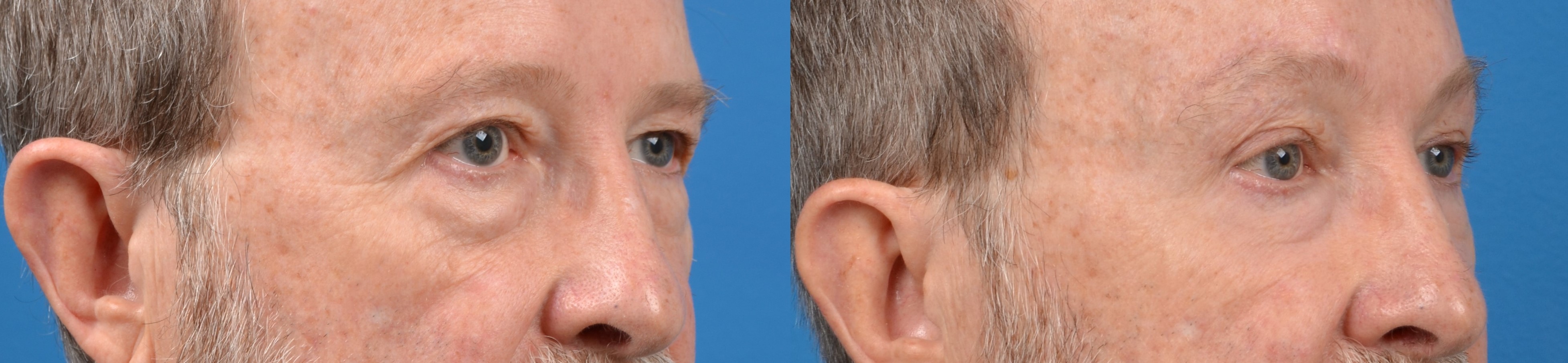Eyelid Surgery Before & After Gallery - Patient 202740 - Image 3