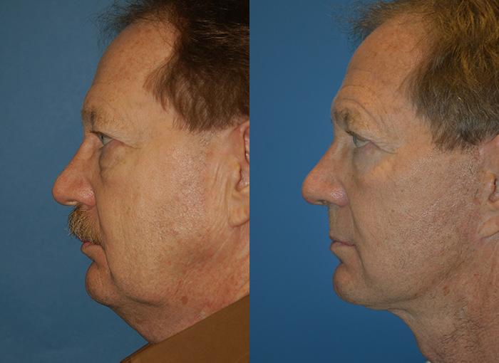 Male Facelift Before & After Gallery - Patient 122406220 - Image 2
