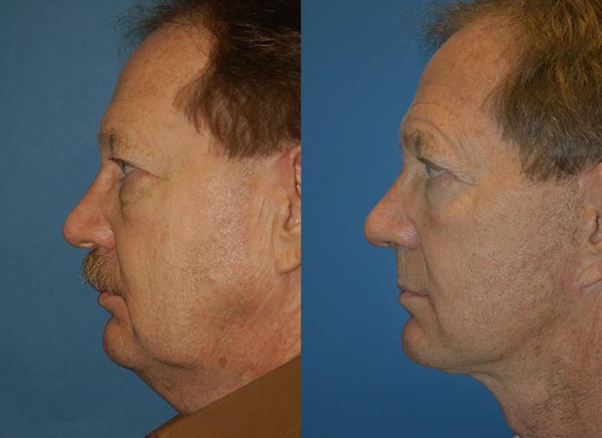 Male Facelift Before & After Gallery - Patient 122406220 - Image 2