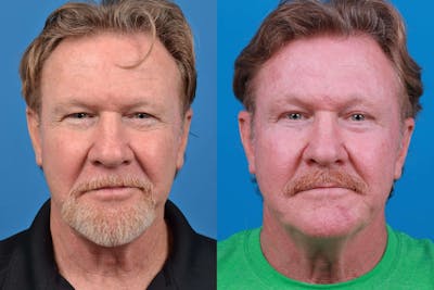 Male Brow Lift Before & After Gallery - Patient 122406223 - Image 1