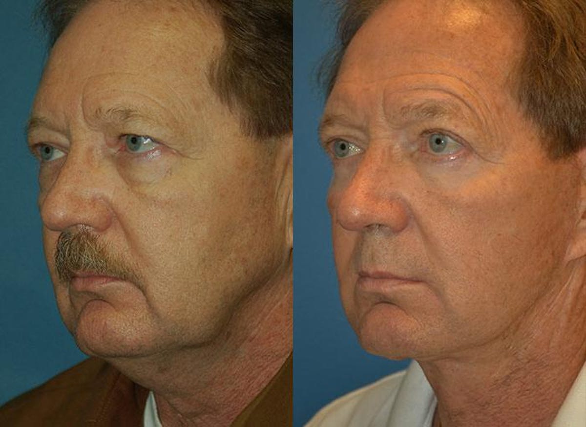 Male Facelift Before & After Gallery - Patient 122406220 - Image 3